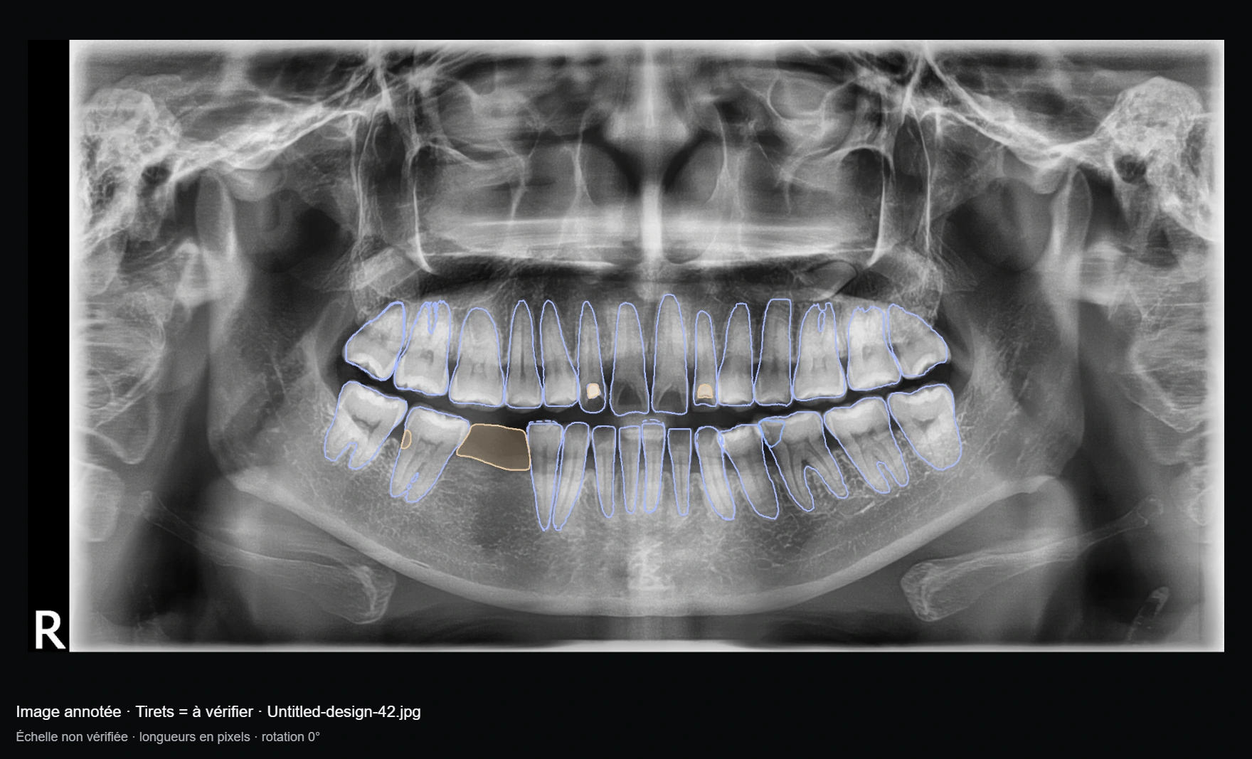 Radiographie panoramique de démonstration avec contours dentaires et annotations à vérifier